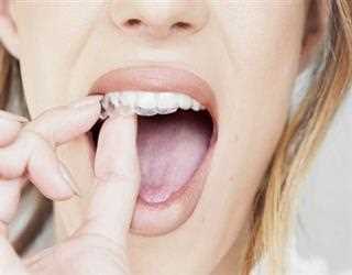 What Are The Advantages of Invisalign