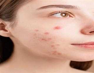 What is Acne?