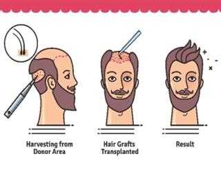 FUT Method of Hair Transplant Treatment in Islamabad