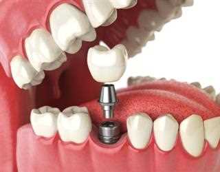10 MAJOR BENEFITS OF DENTAL IMPLANTS