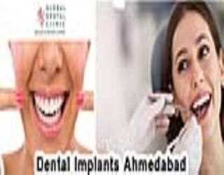 Everything You Ought To Know About Dental Implantation Services