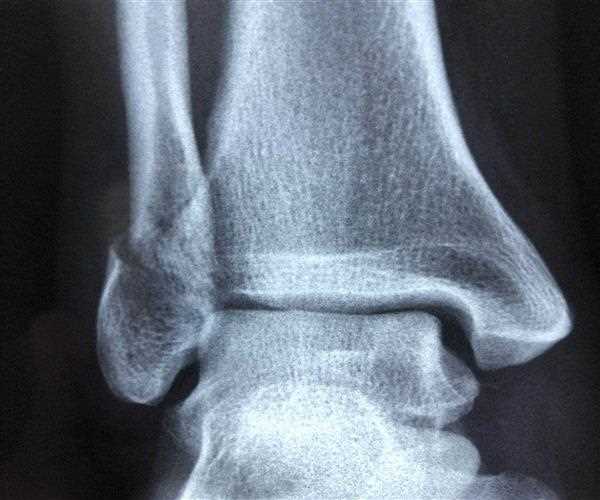 Spiral Fracture: Symptoms, Causes and Diagnoses