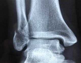Spiral Fracture: Symptoms, Causes and Diagnoses