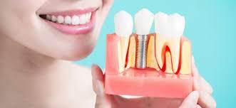 5 Recommendations to Take Care of Your Dental Implants