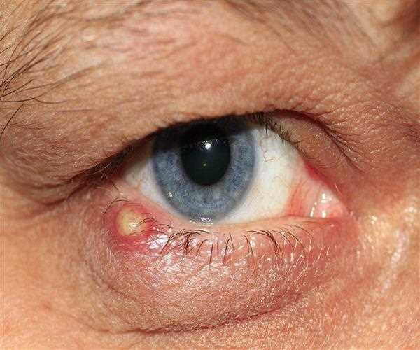 What is Myasthenia Gravis?