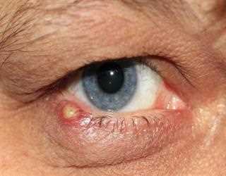 What is Myasthenia Gravis?