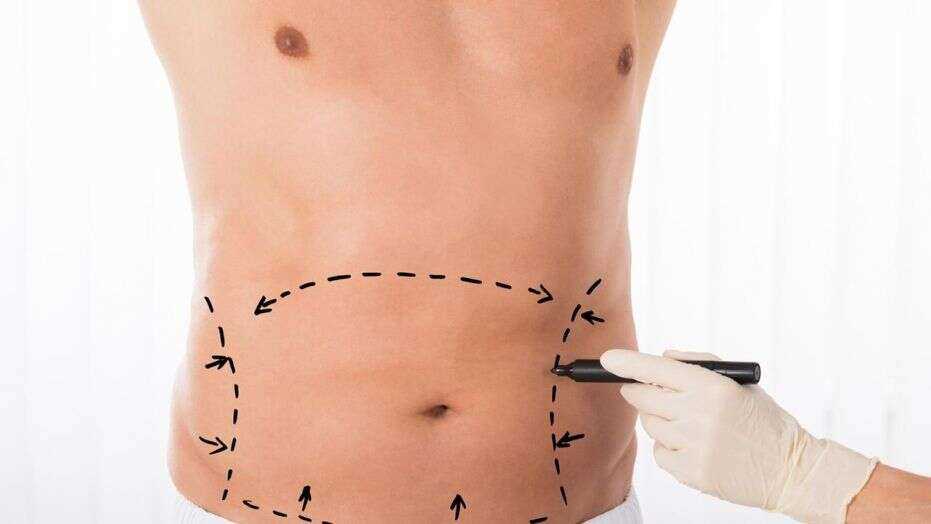 Confusion In Deciding Whether To Have Liposuction Surgery Or Not? Let’s See Its Benefits