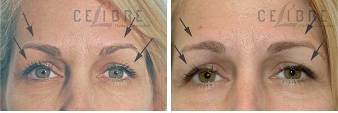 Why is Botox Important ?