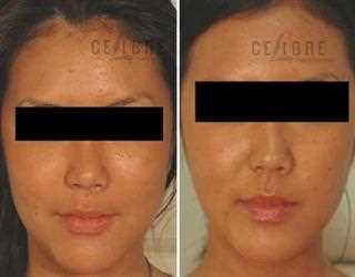 Why is Botox Important ?