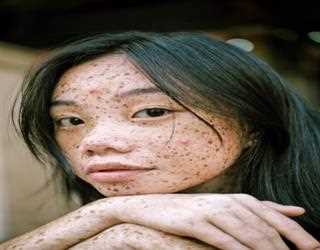 Acute skin Problems