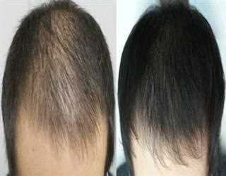 Best FUE Hair Transplant Treatment in Islamabad