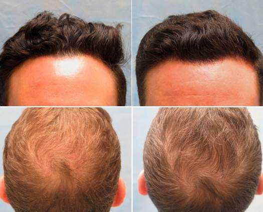 Process for PRP hair loss therapy in Covington