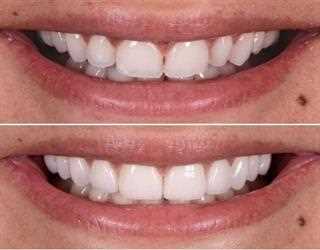 Want to Beam a Perfect Smile Braces can help you out!