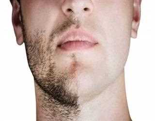 10 Things to Know If You’re Considering a Beard Transplant