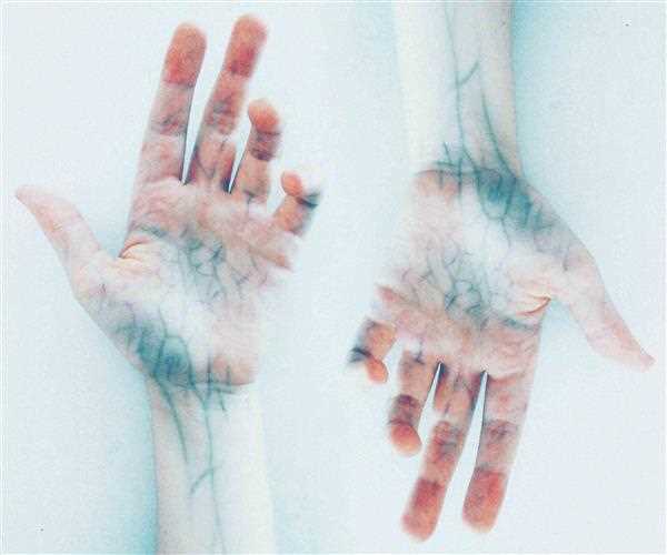 Veins and Artery problems