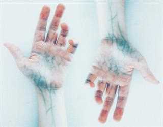 Veins and Artery problems