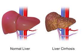 Top 11 Liver Cancer Specialists in India