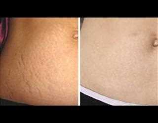 The Possibility of Stretch Marks Removal