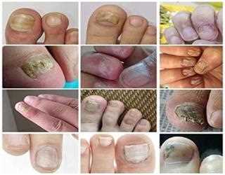 Understand the Callus and Its Treatment Procedures