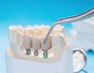 How To Resolve The Problem Of A Missing Tooth with dental therapy?