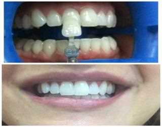 Things that you should keep in mind before having a teeth whitening treatment