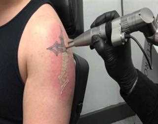 Laser Tattoo Removal