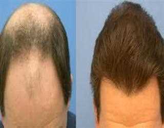 PRP hair treatment in Dubai