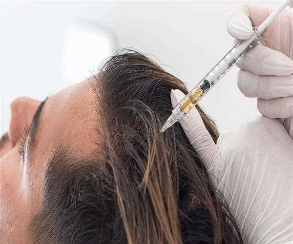 Advanced Hair Loss Treatment: Platelet Rich Plasma