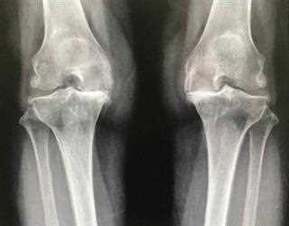 Osteoarthritis – Is it just a degenerative process?