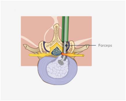 What Happens During a Microdiscectomy?