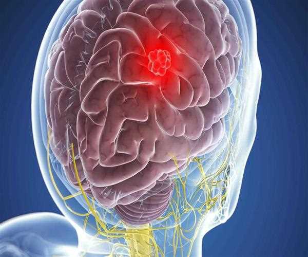 What Is The Survival Rate After Meningioma Treatment?