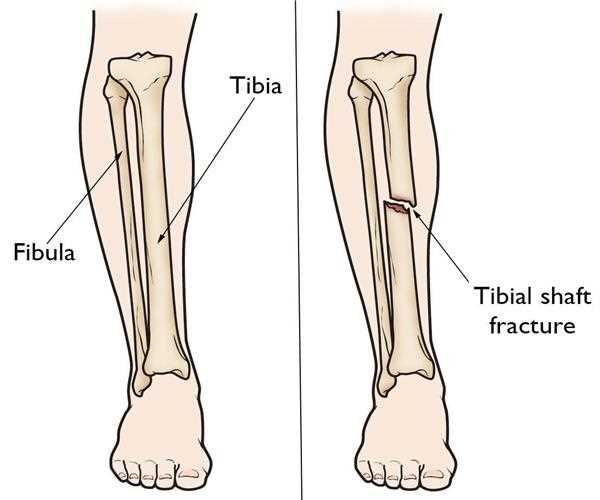 An analysis of Clinical Experience with Closed Tibia Fractures.