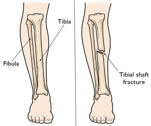 An analysis of Clinical Experience with Closed Tibia Fractures