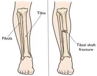 An analysis of Clinical Experience with Closed Tibia Fractures