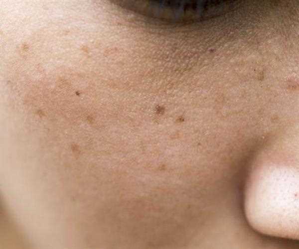 All About Melasma: Symptoms, Causes, and Treatment