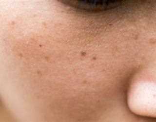 All About Melasma: Symptoms, Causes, and Treatment