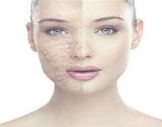 4 Things about Scar Removal image