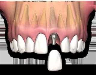 Dental Implant in Udaipur- Types and Procedure