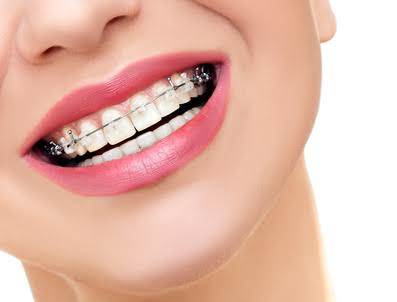 How to Get the Perfect Smile with Orthodontic Treatment?