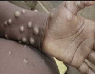 Monkeypox is propagating among gay man globally