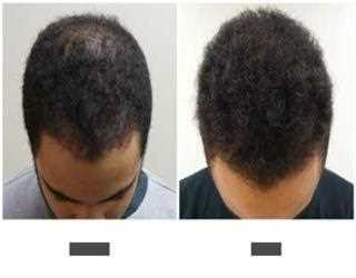 How FUE Hir Transplant Works in Pakistan