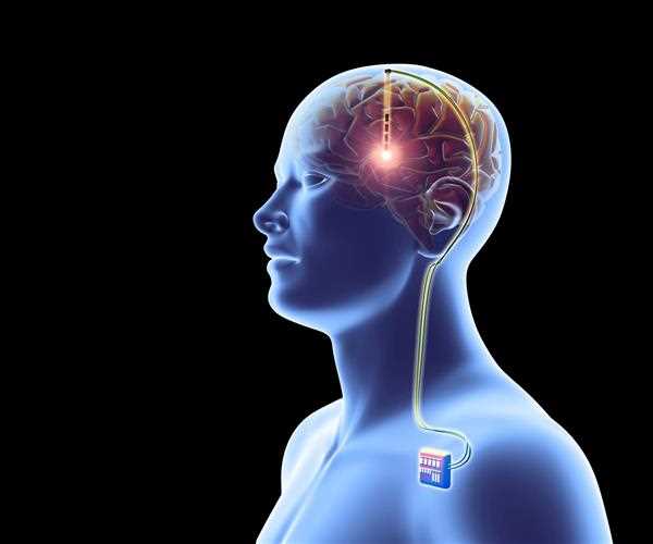 What really means of brain implant? and its impact