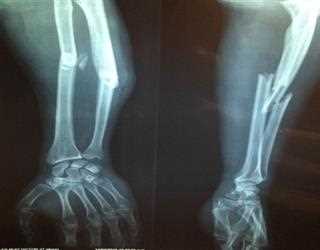 Spiral Fractures: Treatment