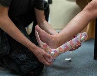 Cauda Equina Syndrome: What is it and It's Types