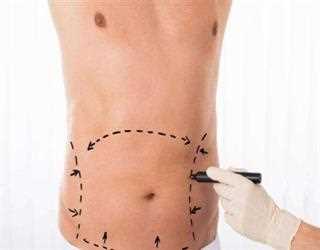 Confusion In Deciding Whether To Have Liposuction Surgery Or Not? Let’s See Its Benefits