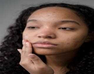 Remedies to Cure acne and darkspots from your Face?