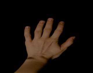 Swollen Fingers: Treatment and Prevention