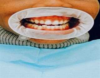 What is Pyorrhea?