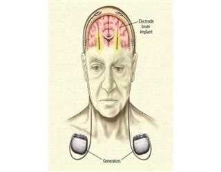 Brain Pacemaker for Parkinson's Treatment