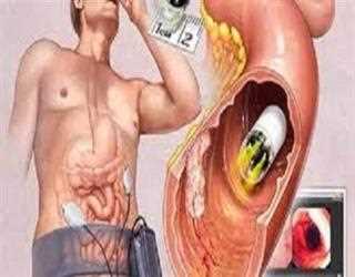 Wireless Capsule Endoscopy